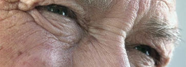diseases age related macular degeneration