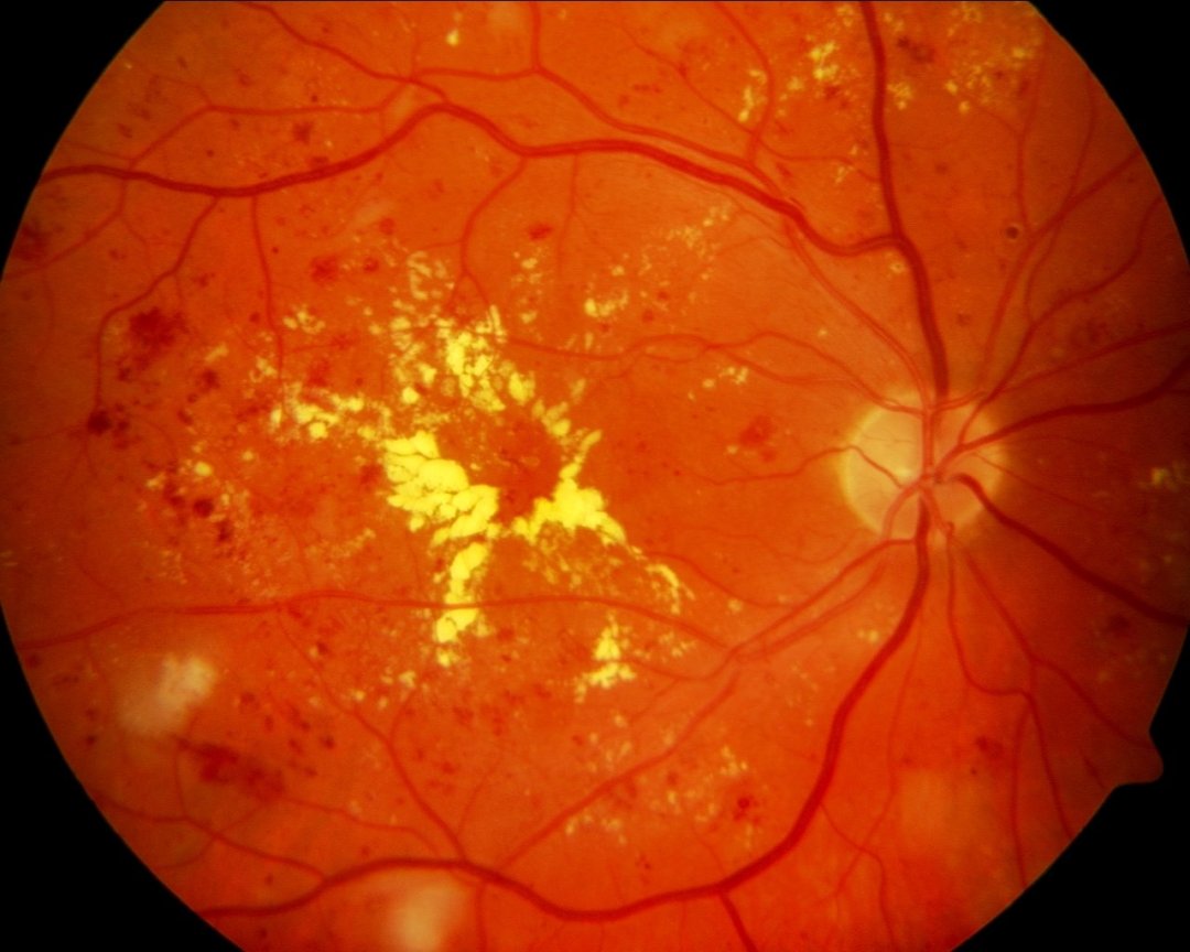 Gozde diyabetik retinopati