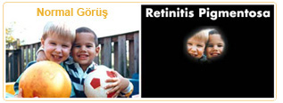 Retinitis Pigmentosa1 hastalık
