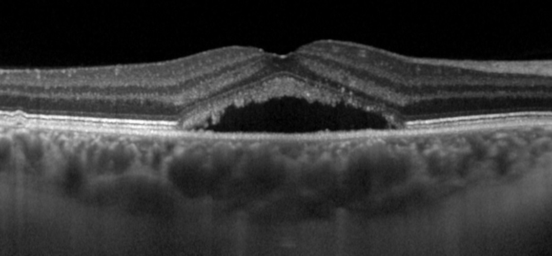 santral seroz retinopati